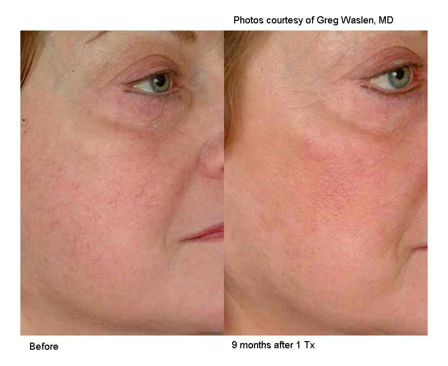 non invasive laser treatment to remove veins on cheeks Calgary