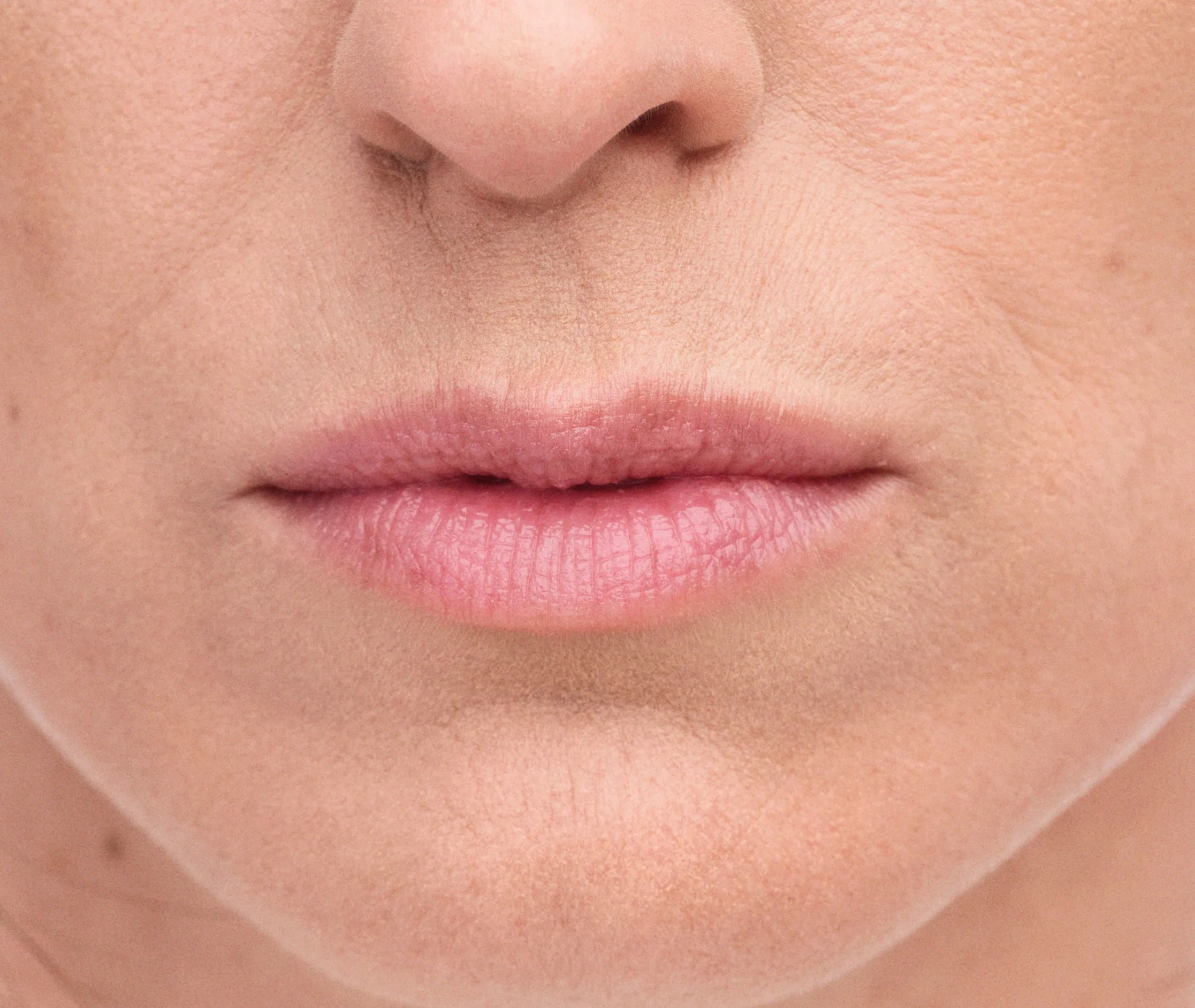 lip filler treatment for wrinkles Calgary