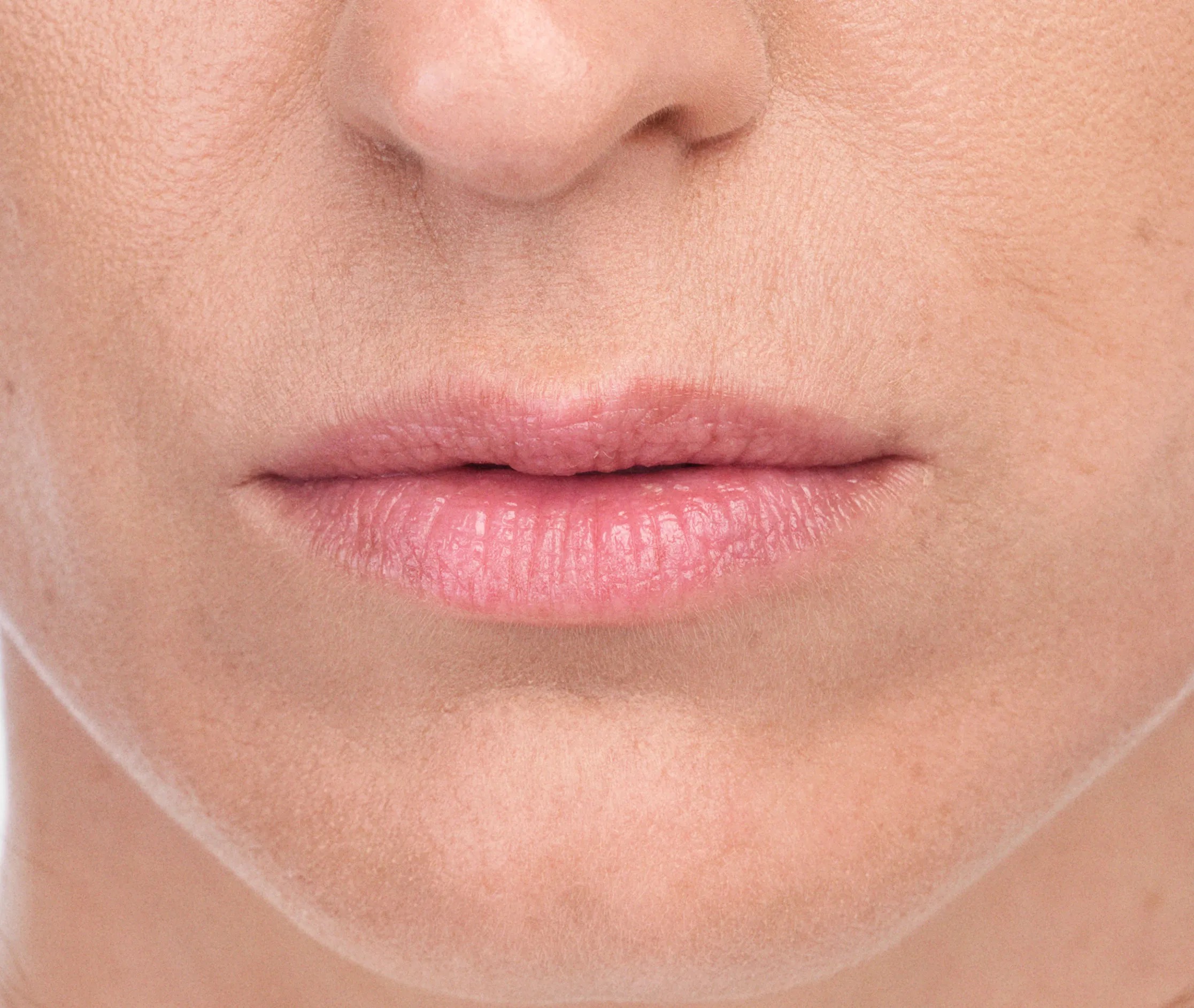 how much does lip filler cost Calgary