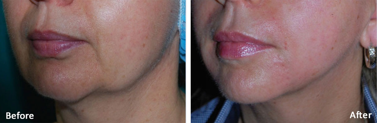 tighten loose skin on face with lasers