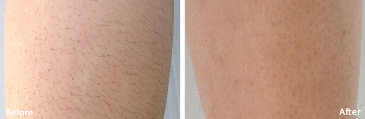 leg hair removal with laser in Calgary