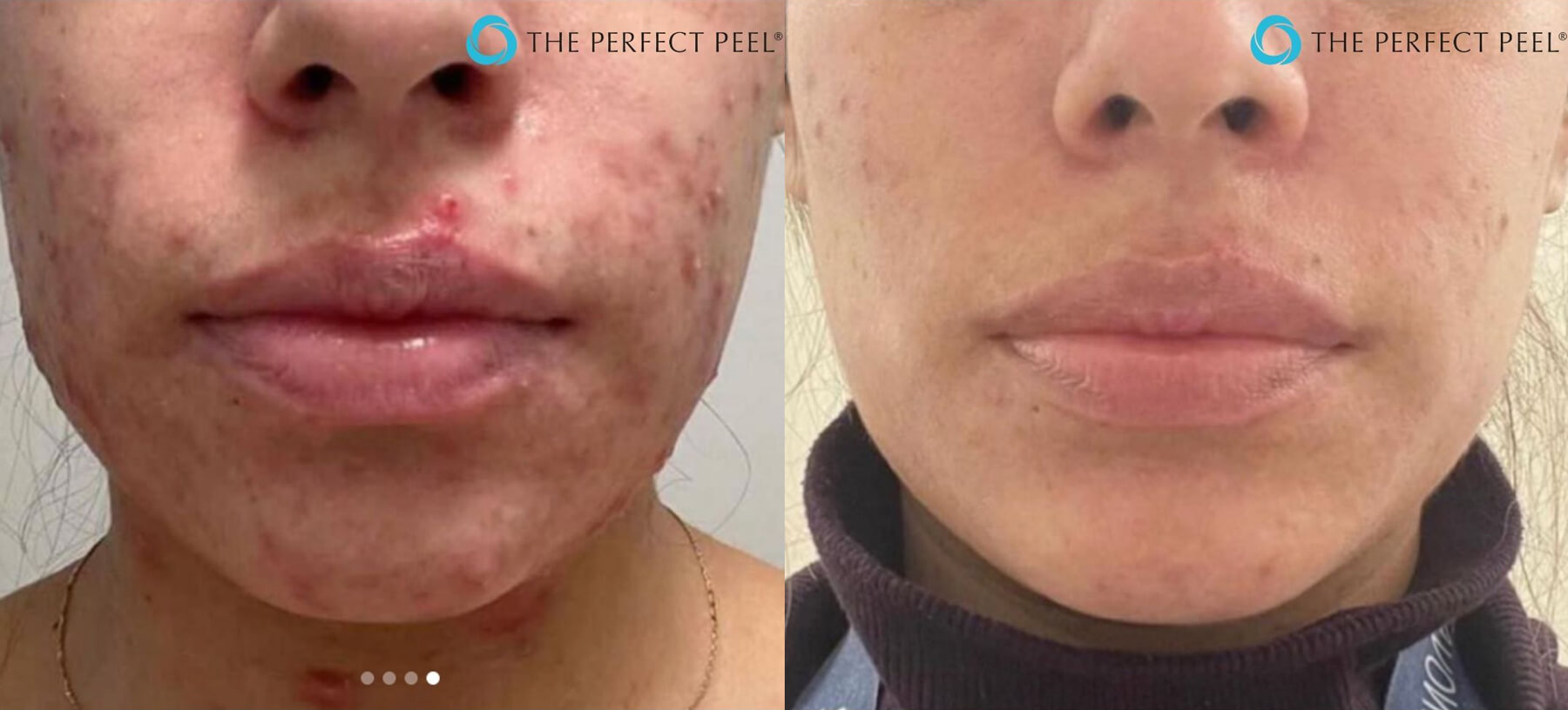 chemical peel to reduce acne breakout