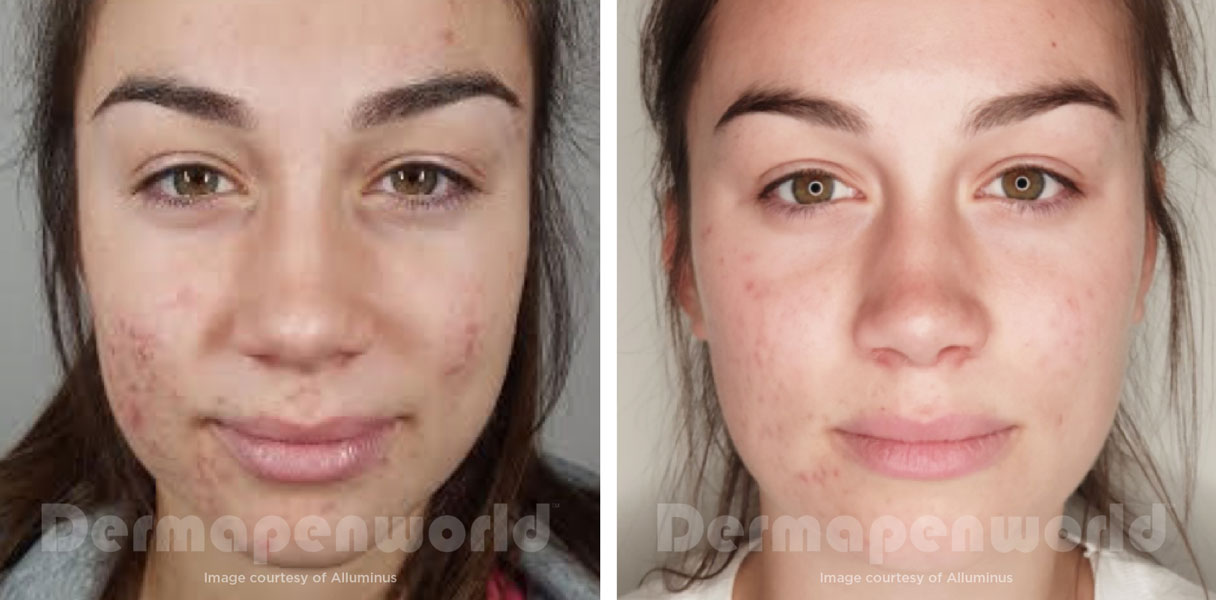 younger looking skin without acne