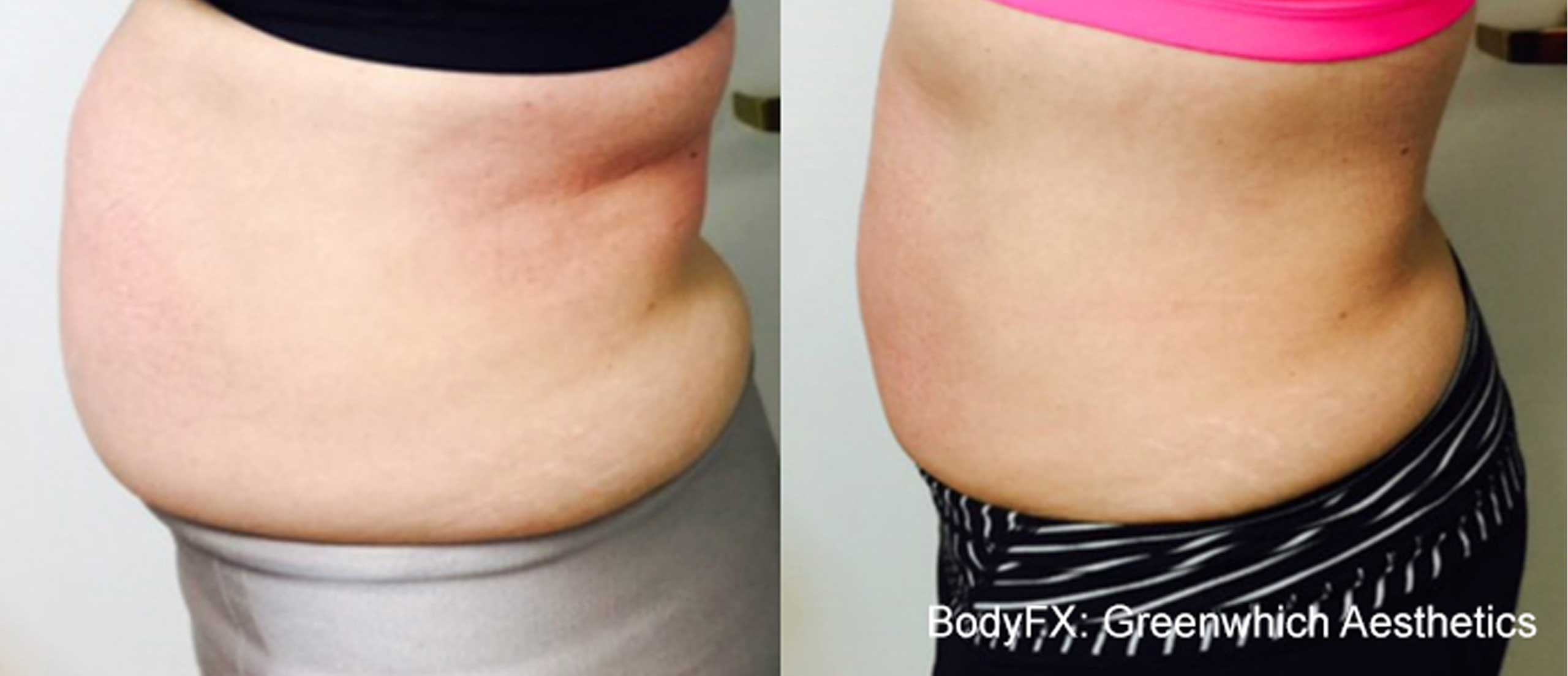 postpartum belly fat reducer in calgary