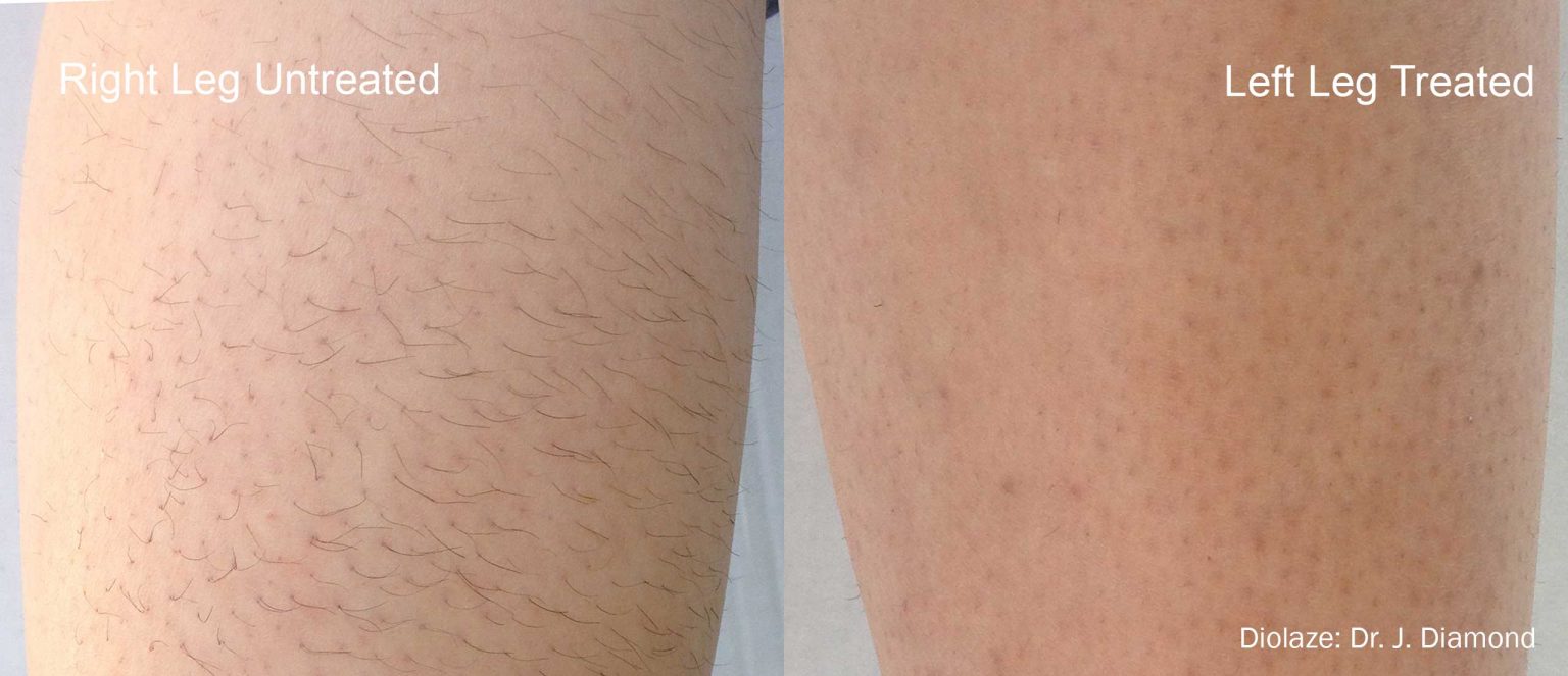 get rid of hairy legs permanently in calgary