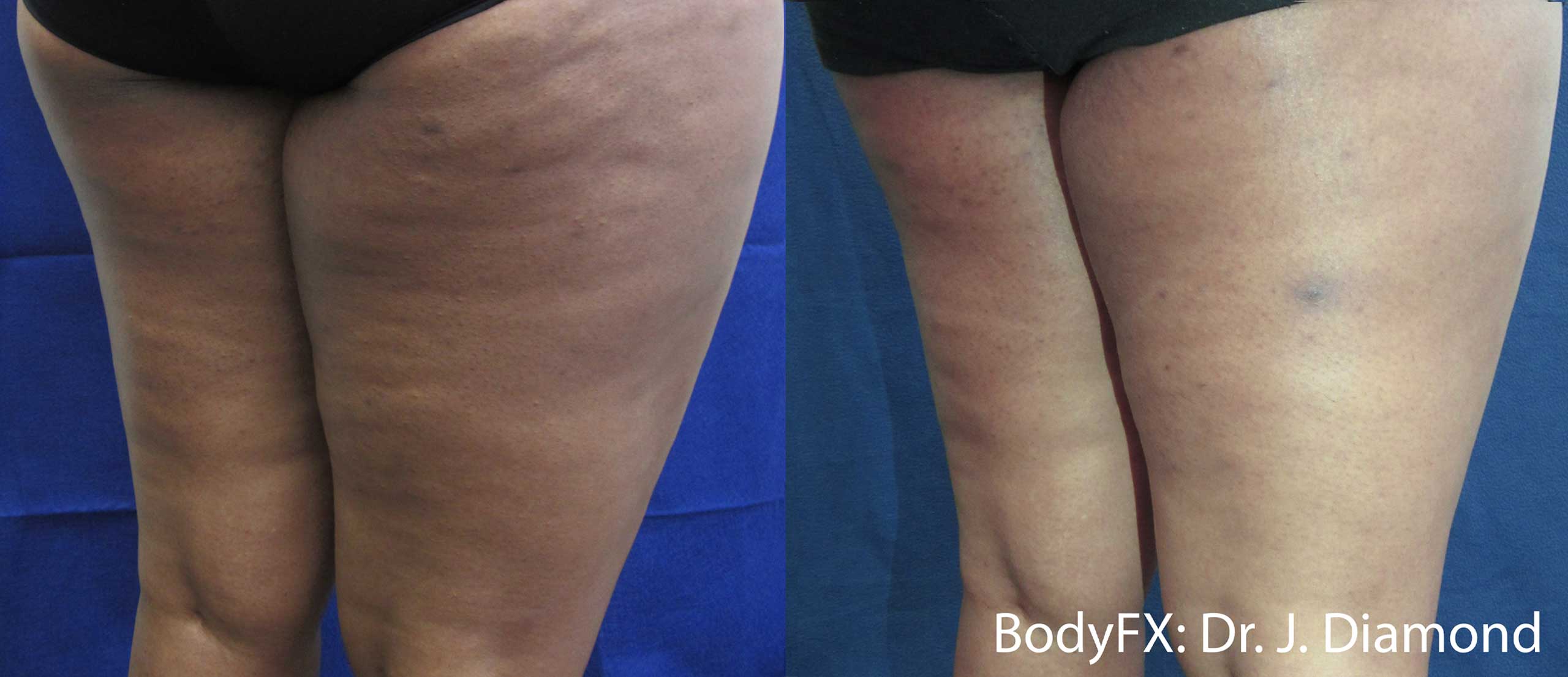 easy and painless cellulite treatment for older women