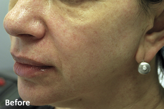 remove rad marks on face calgary
