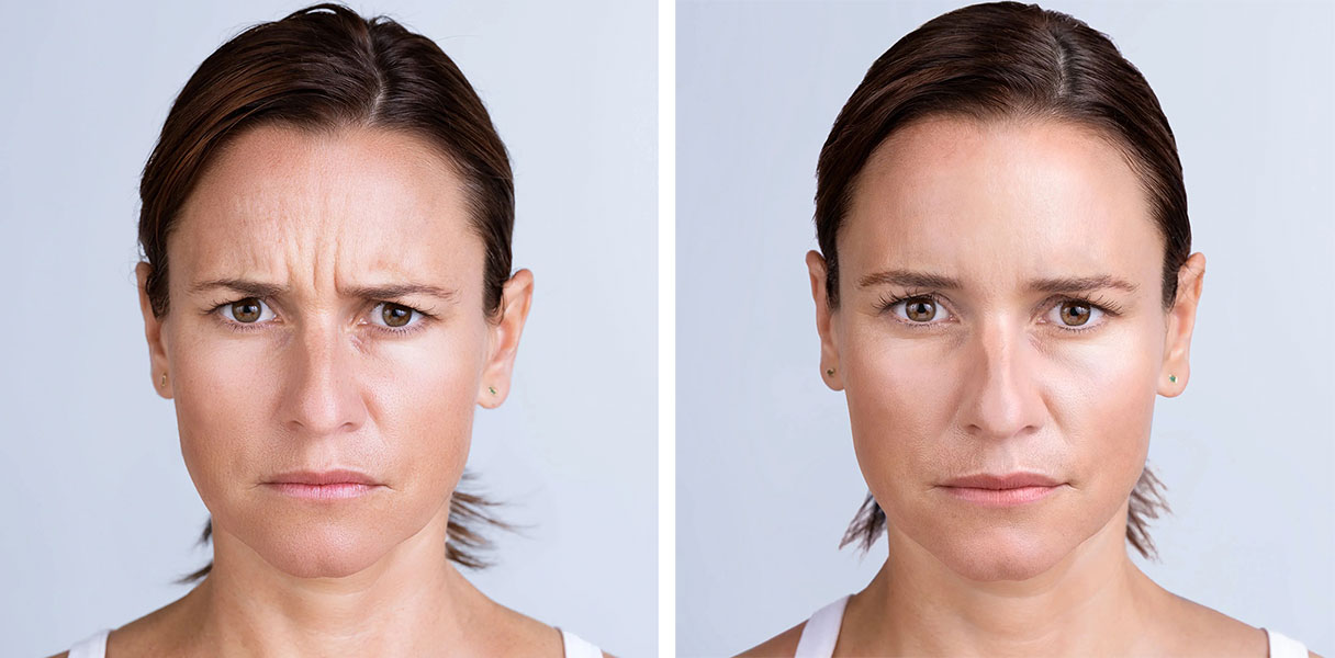 reduce frown lines with injections in Calgary
