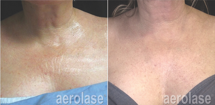 smooth out chest wrinkles with neoskin in Calgary