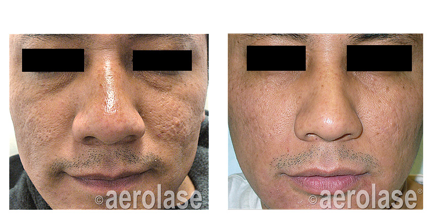 lose acne scars on face in Calgary