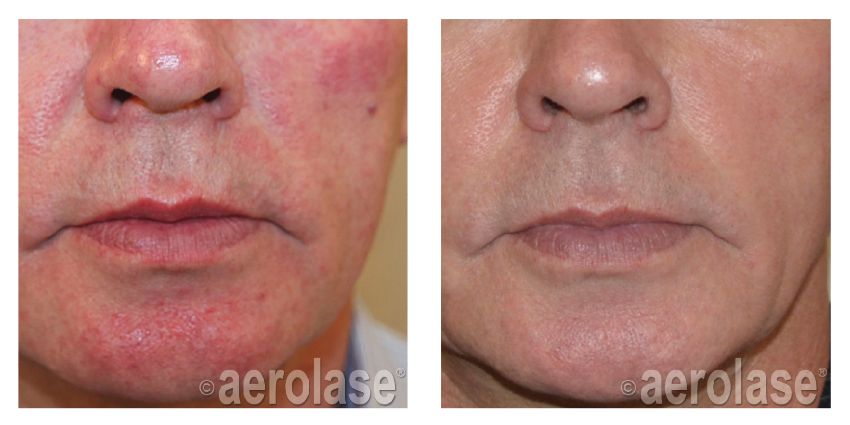 reduce red patches on face with treatment in Calgary
