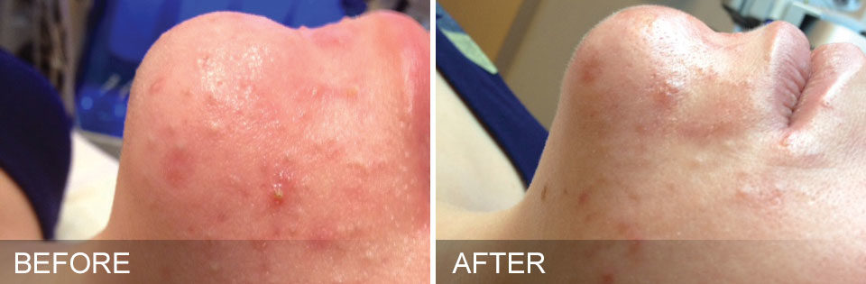 better looking skin with chemical peels in Calgary