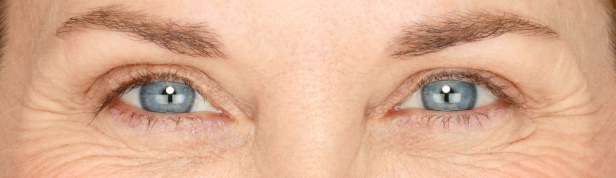 wrinkle-free skin with cosmetic treatment in calgary